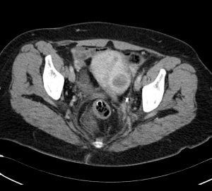CT scan of uterine fibroids