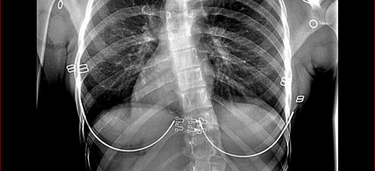 X-Ray Of Scoliosis