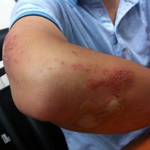 closeup of elbow with road rash