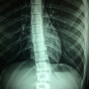 spinal cord injury xray