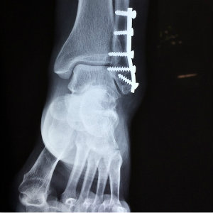 xray of foot with screws